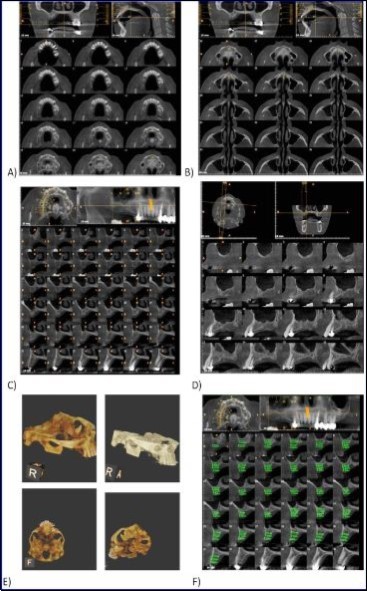 Journal of Dentistry And Oral Implants-CBCT