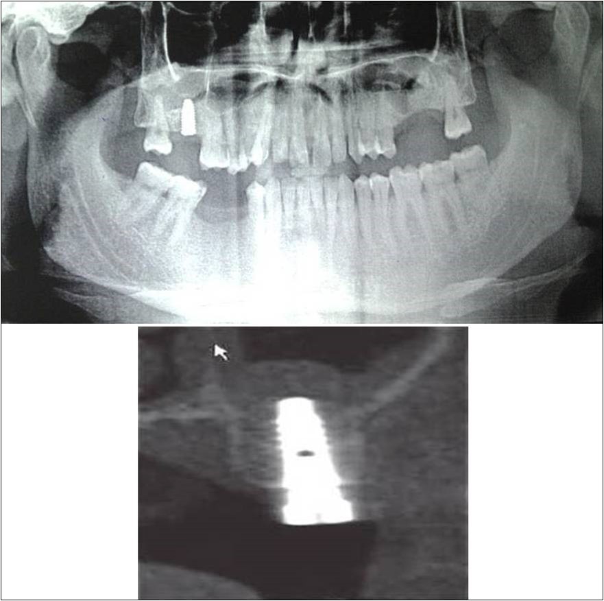 Journal of Dentistry And Oral Implants-Indirect sinus augmentation