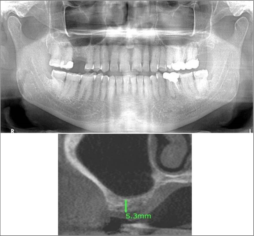 Journal of Dentistry And Oral Implants-Indirect sinus augmentation