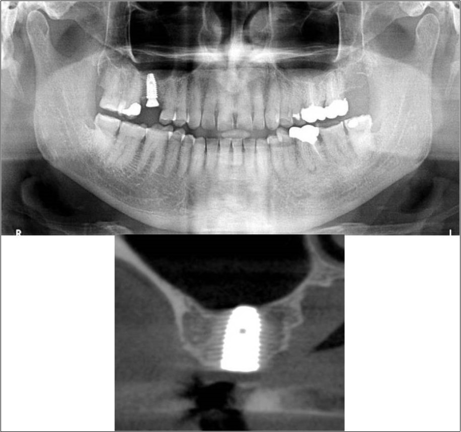Journal of Dentistry And Oral Implants-Indirect sinus augmentation