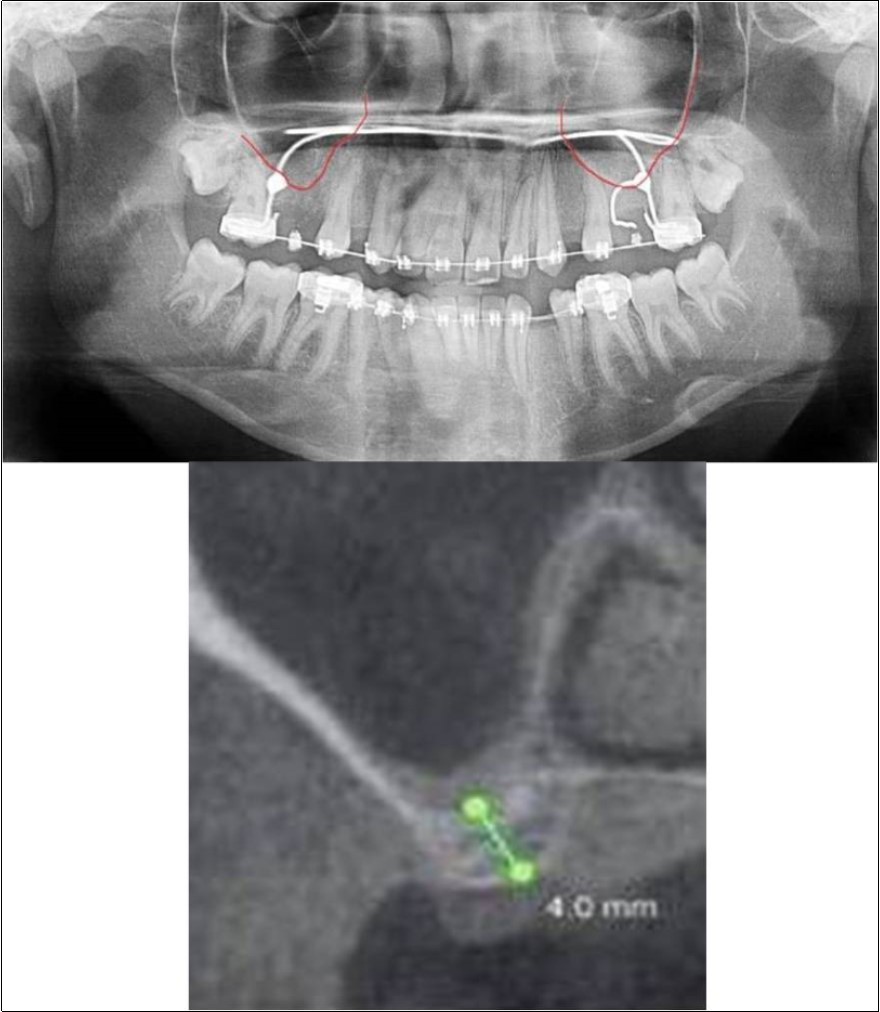 Journal of Dentistry And Oral Implants-Indirect sinus augmentation