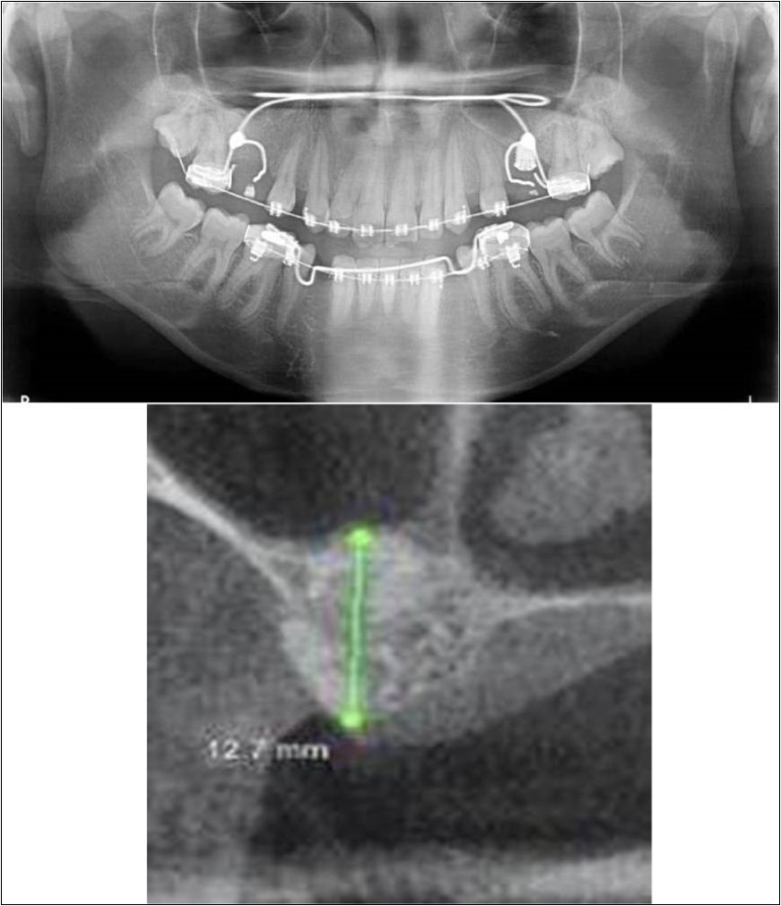 Journal of Dentistry And Oral Implants-Indirect sinus augmentation