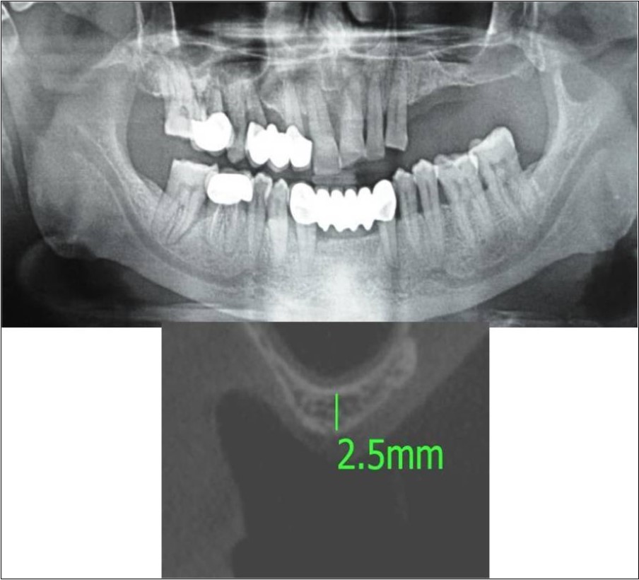 Journal of Dentistry And Oral Implants-Indirect sinus augmentation