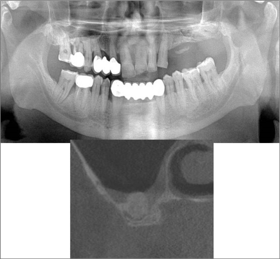 Journal of Dentistry And Oral Implants-Indirect sinus augmentation