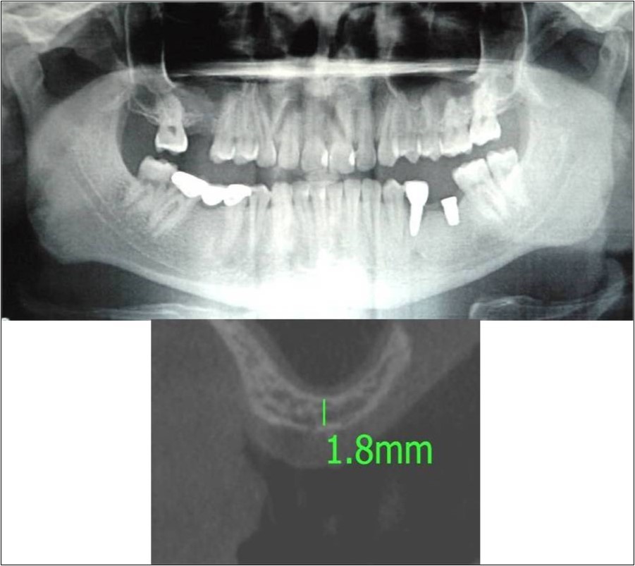 Journal of Dentistry And Oral Implants-Indirect sinus augmentation