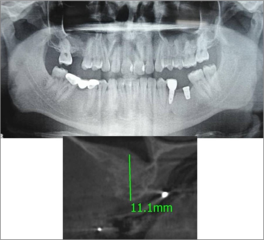 Journal of Dentistry And Oral Implants-Indirect sinus augmentation