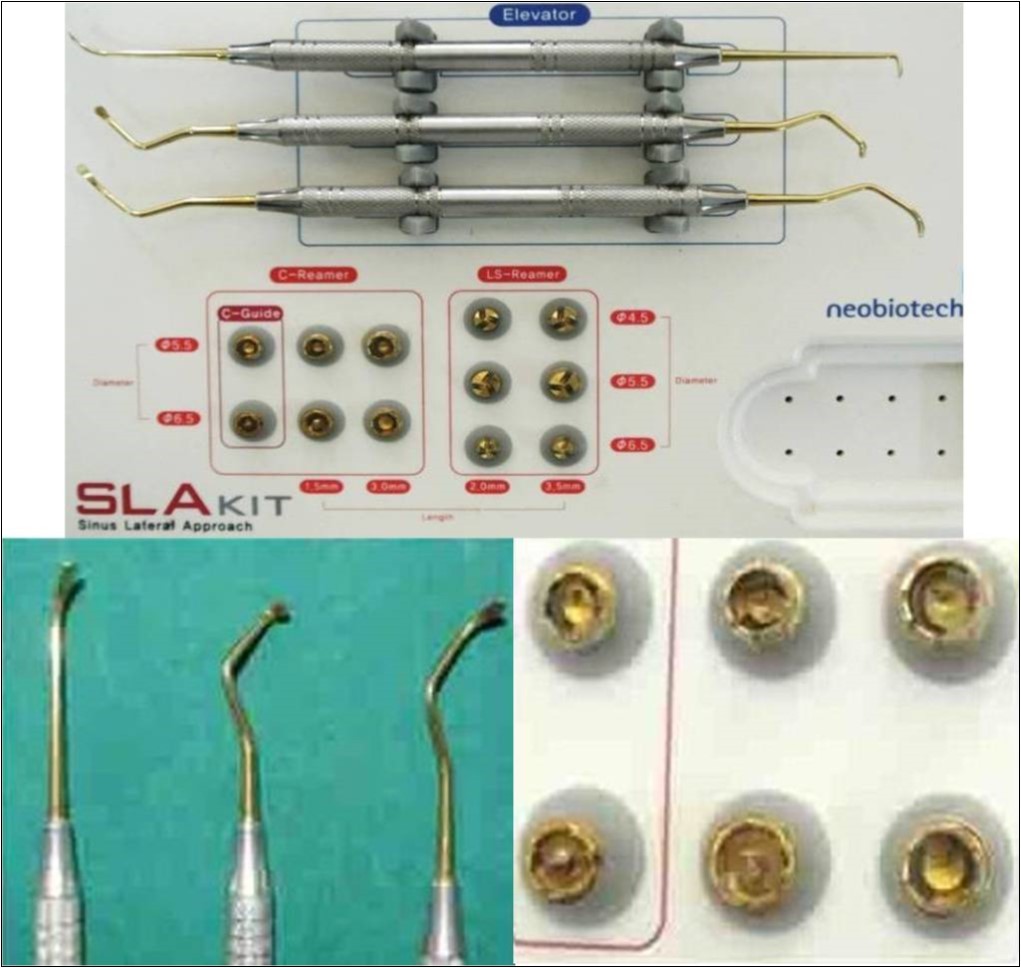 Journal of Dentistry And Oral Implants-Indirect sinus augmentation