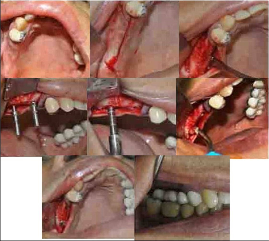 Journal of Dentistry And Oral Implants-Indirect sinus augmentation