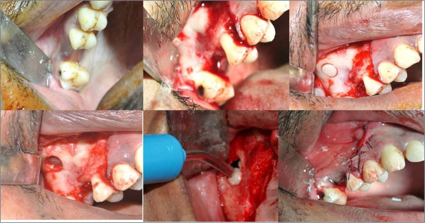 Journal of Dentistry And Oral Implants-Indirect sinus augmentation