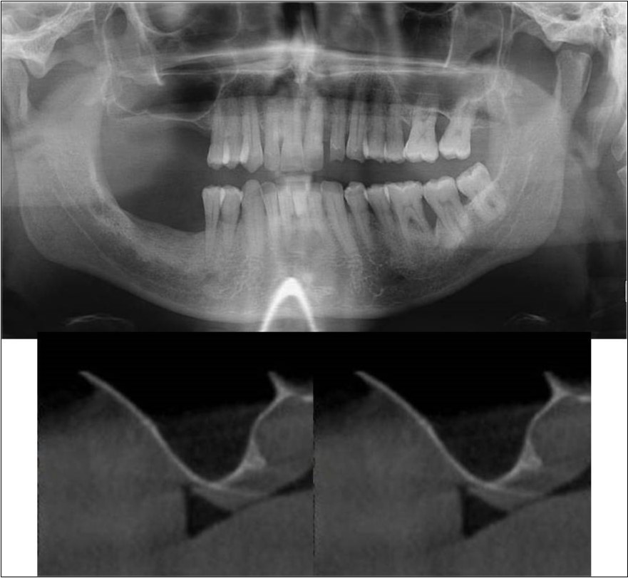Journal of Dentistry And Oral Implants-Indirect sinus augmentation