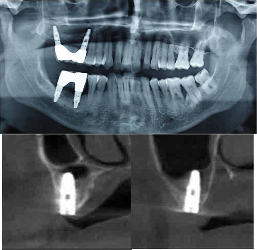Journal of Dentistry And Oral Implants-Indirect sinus augmentation