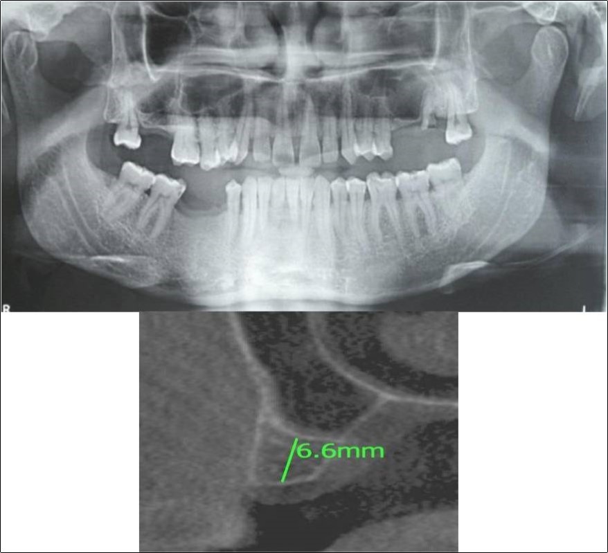 Journal of Dentistry And Oral Implants-Indirect sinus augmentation