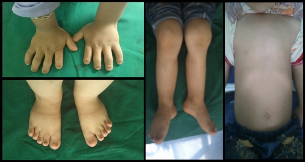 Journal of Dentistry And Oral Implants-Ellis-Van Creveld syndrome