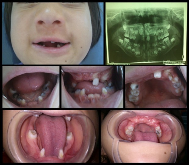 Journal of Dentistry And Oral Implants-Ellis-Van Creveld syndrome