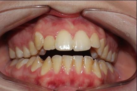 Journal of Dentistry And Oral Implants-mini-implants