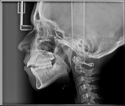 Journal of Dentistry And Oral Implants-mini-implants