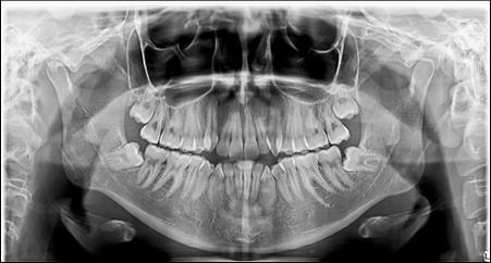 Journal of Dentistry And Oral Implants-mini-implants