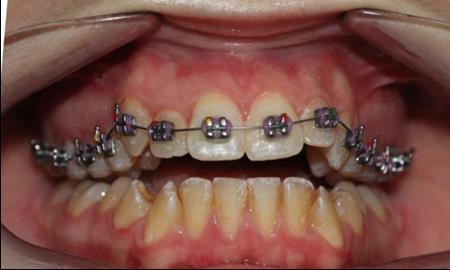Journal of Dentistry And Oral Implants-mini-implants
