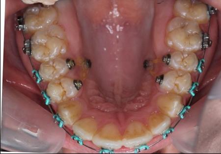Journal of Dentistry And Oral Implants-mini-implants