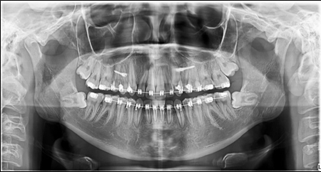 Journal of Dentistry And Oral Implants-mini-implants