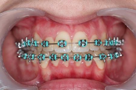 Journal of Dentistry And Oral Implants-mini-implants