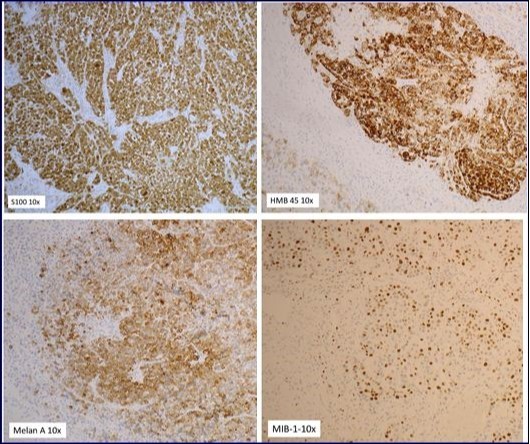 Journal Of Digestive Disorders And Diagnosis-parotid gland