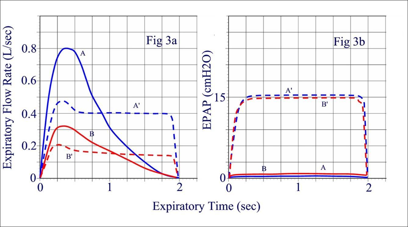 Journal of Sleep and Sleep Disorder Research-obstructive sleep apnea