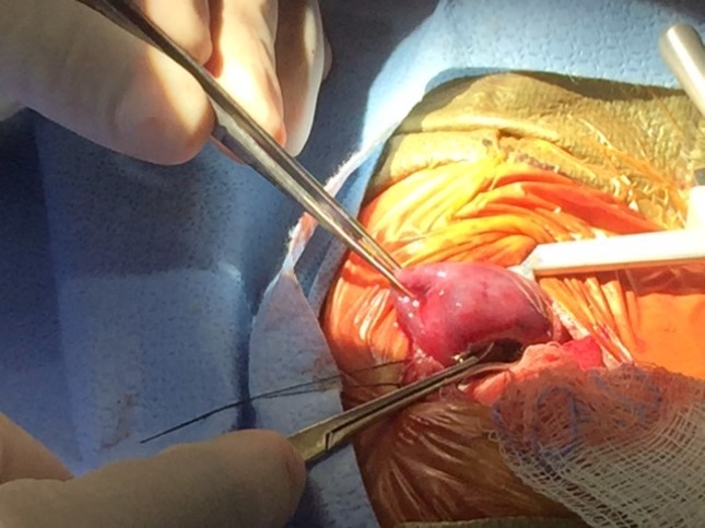 Journal of Fetal Surgery-Congenital Pulmonary airway malformation (CPAM)