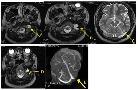 Journal of Neurological Research and Therapy-Lemierre’s syndrome