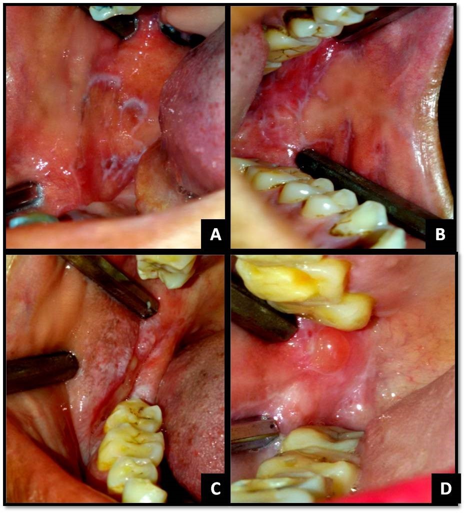 Journal of Dermatologic Research And Therapy-Lichen planus