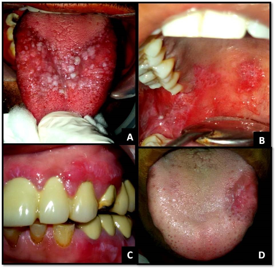 Journal of Dermatologic Research And Therapy-Lichen planus