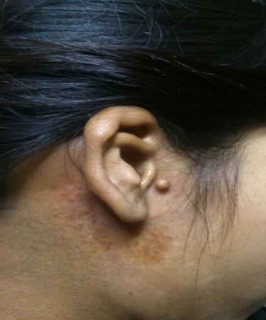Journal of Otolaryngology Advances-Congenital Aural Atresia
