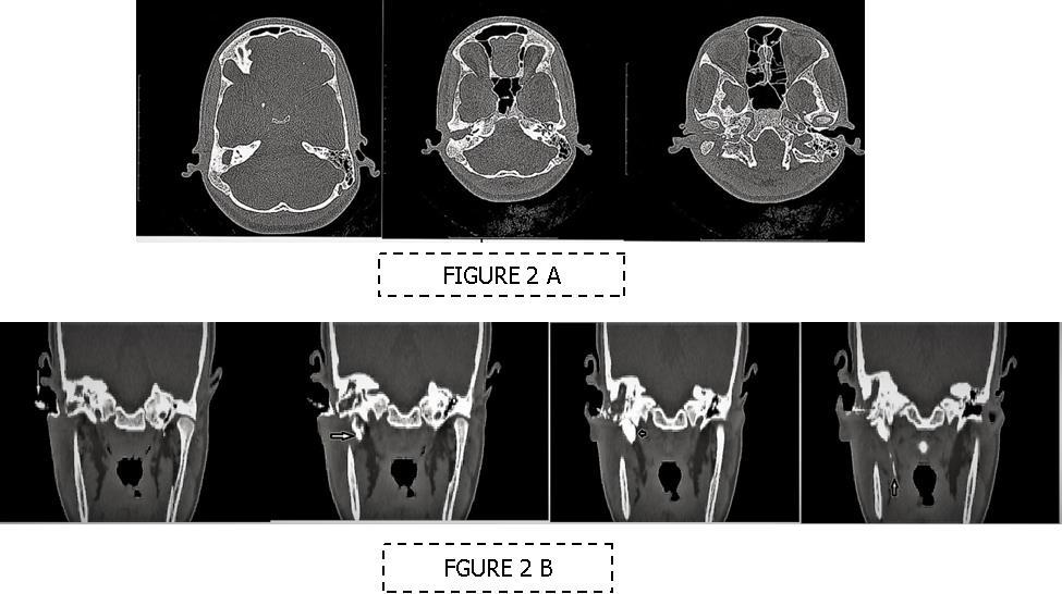 Journal of Otolaryngology Advances-Congenital Aural Atresia