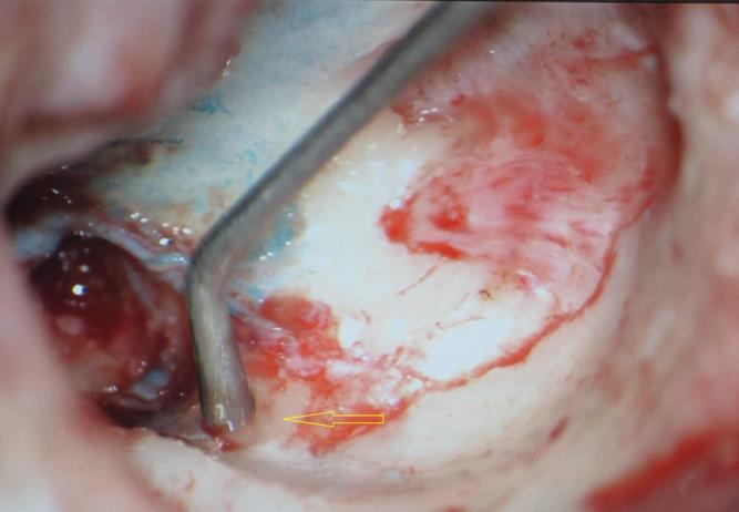 Journal of Otolaryngology Advances-Congenital Aural Atresia