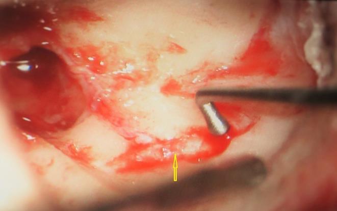 Journal of Otolaryngology Advances-Congenital Aural Atresia