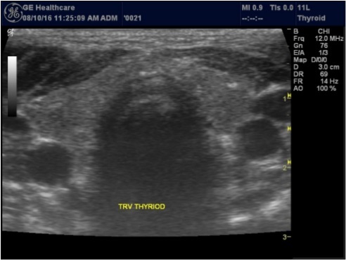 Journal of Hematalogy and Oncology Research-Thyroid Gland