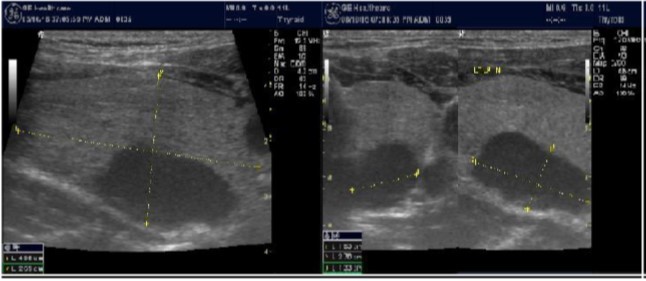 Journal of Hematalogy and Oncology Research-Thyroid Gland