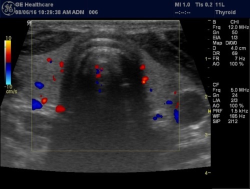 Journal of Hematalogy and Oncology Research-Thyroid Gland