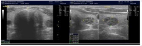 Journal of Hematalogy and Oncology Research-Thyroid Gland