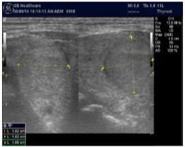 Journal of Hematalogy and Oncology Research-Thyroid Gland