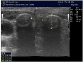 Journal of Hematalogy and Oncology Research-Thyroid Gland