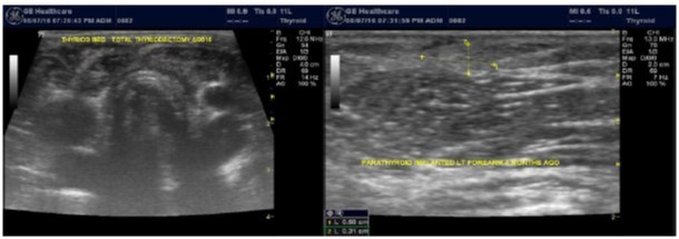 Journal of Hematalogy and Oncology Research-Thyroid Gland