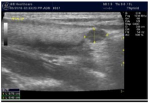 Journal of Hematalogy and Oncology Research-Thyroid Gland