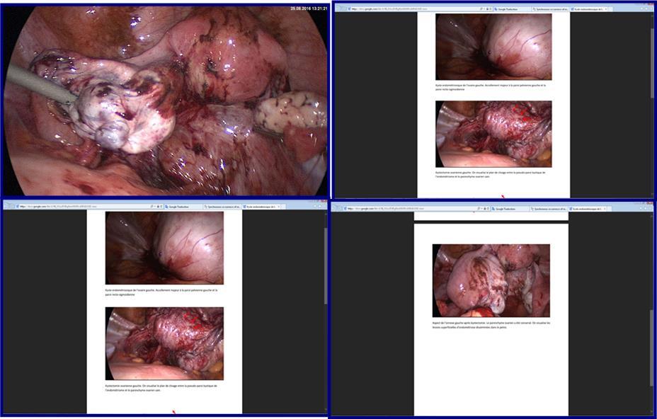 Journal of Digestive Disorders and Diagnosis -Mature teratoma cystic