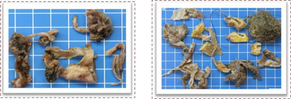 Journal of Digestive Disorders and Diagnosis -Mature teratoma cystic