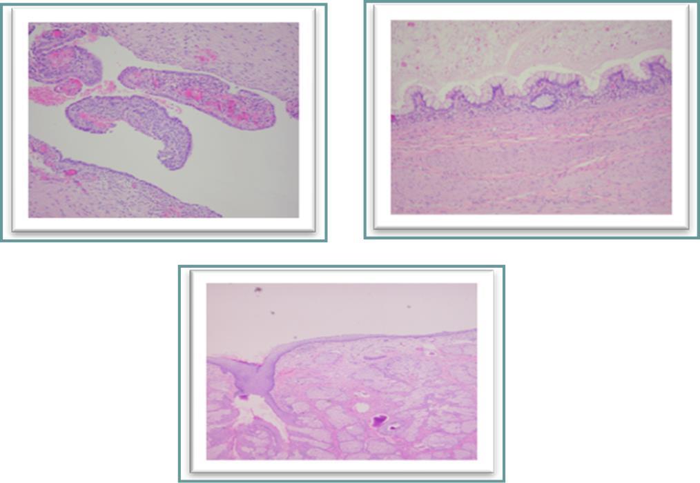 Journal of Digestive Disorders and Diagnosis -Mature teratoma cystic