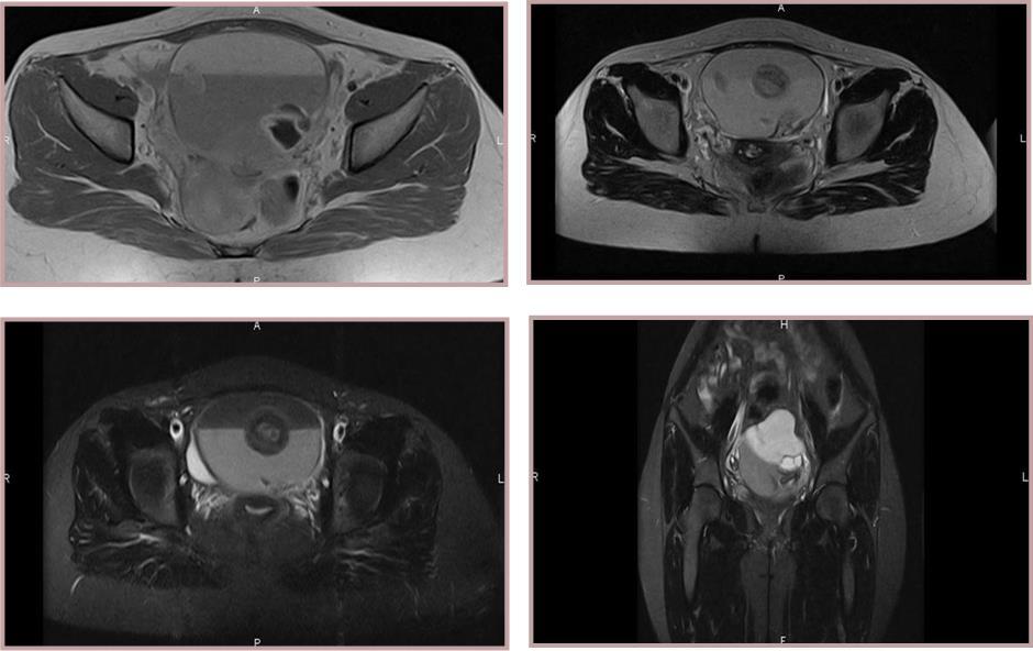 Journal of Digestive Disorders and Diagnosis -Mature teratoma cystic