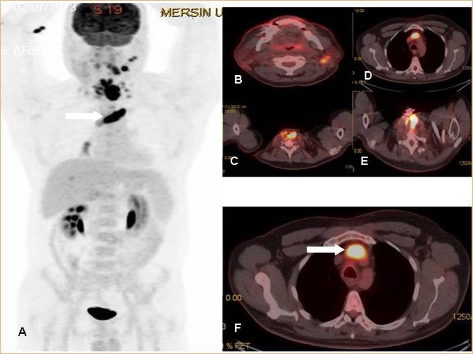 Journal of Otolaryngology Advances-Laringeal cancer