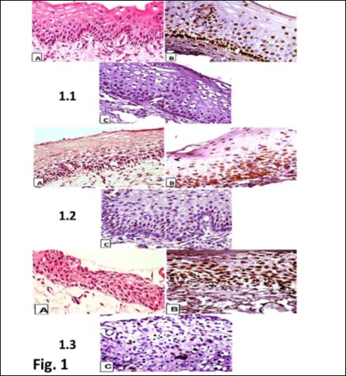 Journal of Cancer Genetics And Biomarkers-p16