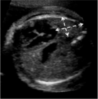 Congenital diaphragmatic hernia